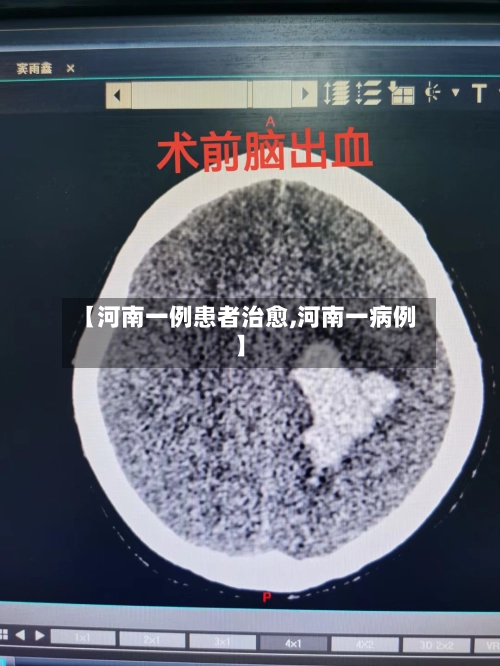 【河南一例患者治愈,河南一病例】-第2张图片