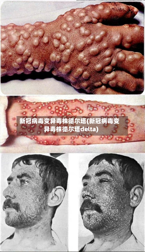 新冠病毒变异毒株德尔塔(新冠病毒变异毒株德尔塔delta)